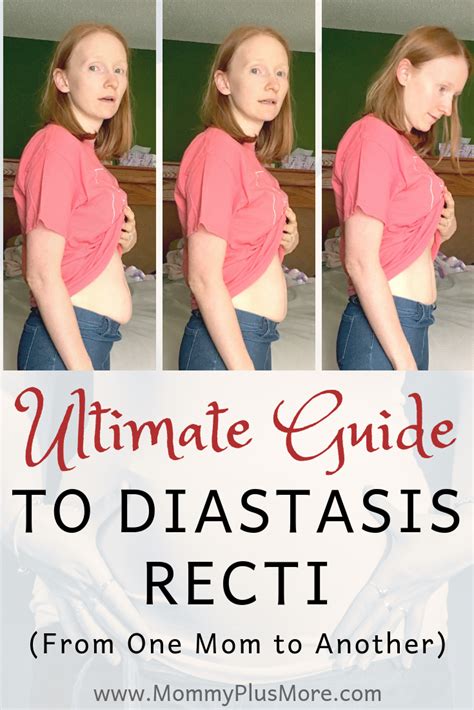 how does diastasis recti look